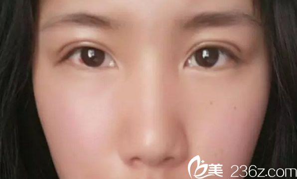 全切雙眼皮七天拆線