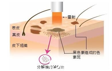 激光祛斑原理