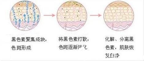 激光祛斑如何防曬