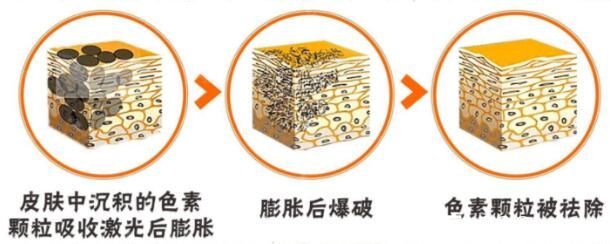 激光祛斑術(shù)后注意事項