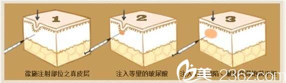 玻尿酸去除淚溝