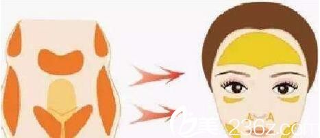 自體脂肪填充淚溝