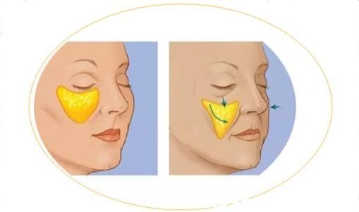 淚溝填充術(shù)后注意事項(xiàng)