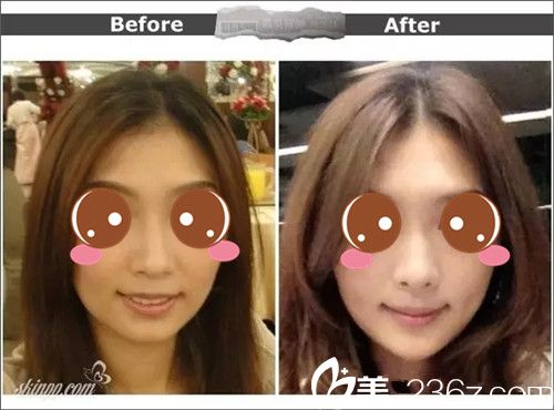 玻尿酸豐下巴案例對比