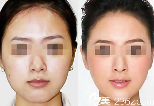 太原歐美蓮白立明面部線雕效果圖