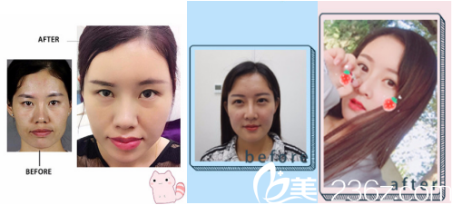 煙臺華怡醫(yī)學美容醫(yī)院自體脂肪填充案例