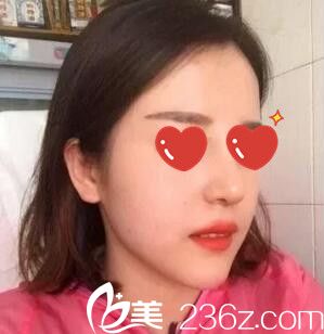 做鼻綜合+假體墊下巴術(shù)后半個月 做鼻綜合+假體墊下巴術(shù)后半個月