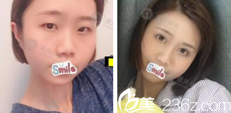 重慶華美張國強(qiáng)做雙眼皮怎么樣