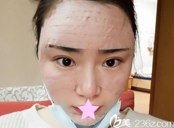 自體脂肪填充全臉天