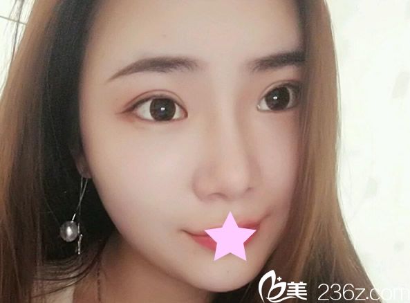 全臉脂肪填充第15天照片