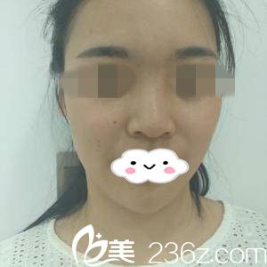 手術(shù)前的我 手術(shù)前的我