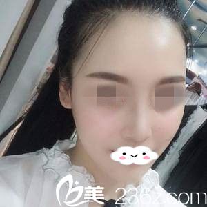 隆鼻一周后 隆鼻一周后