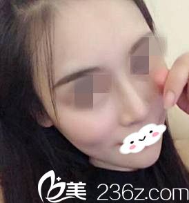 我在整形醫(yī)院做的假體隆鼻術(shù)后一個(gè)月，輕松擁有了自然的小翹鼻