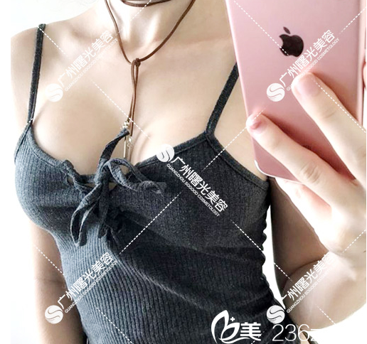 在廣州曙光整形醫(yī)院做完假體隆胸術(shù)后一個(gè)月