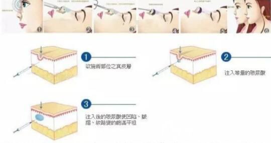 玻尿酸手術(shù)