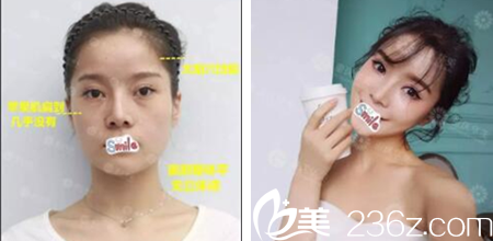 重慶華美李富強自體脂肪面部填充案例 重慶華美李富強自體脂肪面部填充案例