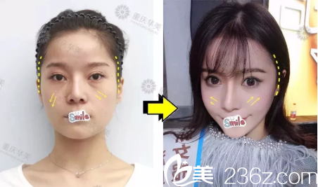 李富強自體脂肪全臉填充案例 李富強自體脂肪全臉填充案例