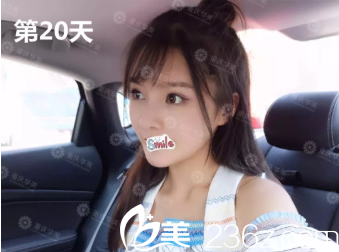 20天后效果 20天后效果