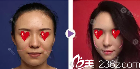 重慶華美脂肪填充蘋果肌案例 重慶華美脂肪填充蘋果肌案例