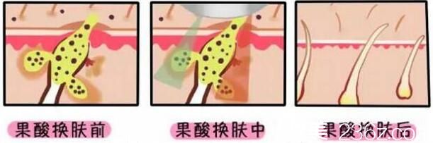 果酸換膚前后對(duì)比