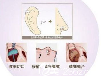 自體耳軟骨墊鼻尖