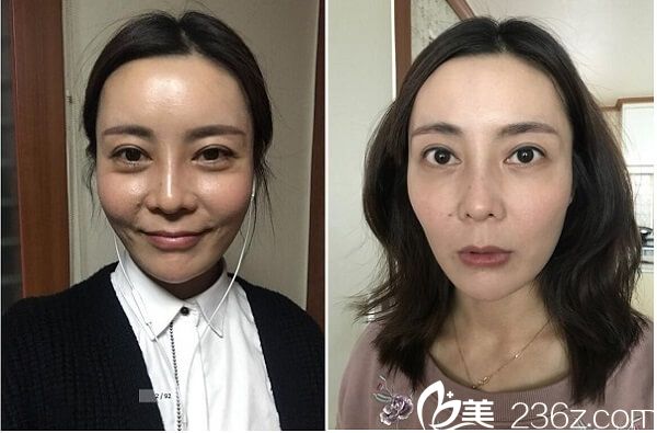 隆鼻前照片 隆鼻前照片