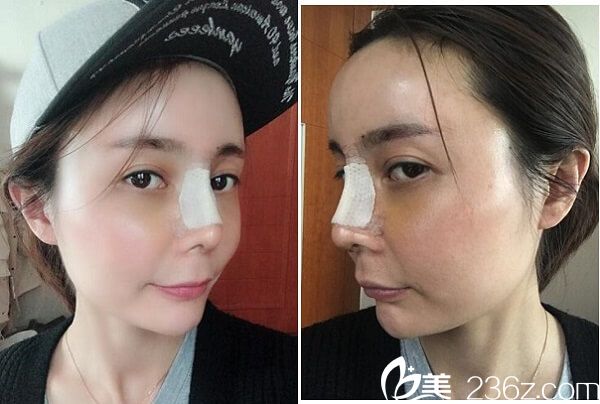 在韓國碧夏整形做自體 軟骨隆鼻5天了 在韓國碧夏整形做自體 軟骨隆鼻5天了