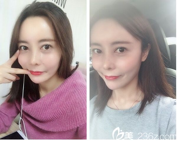 自體軟骨+自體脂肪填充全臉后22天 自體軟骨+自體脂肪填充全臉后22天