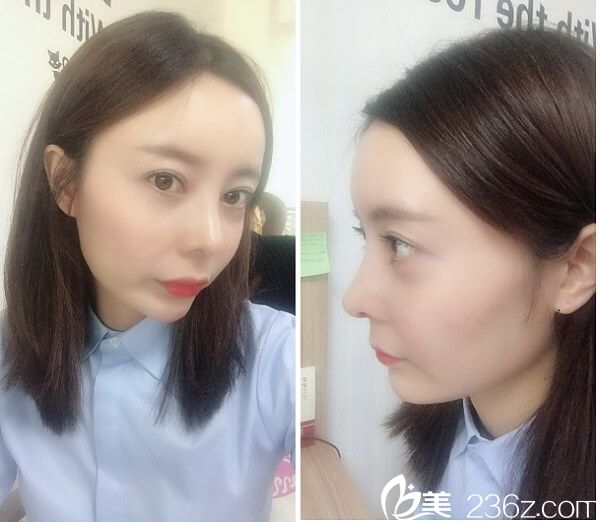 給大家分享下我去韓國碧夏醫(yī)院做肋軟骨隆鼻+自體脂肪填充全臉后的真實經(jīng)歷和恢復過程