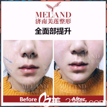 濟(jì)南美蓮（原美萊）整形醫(yī)院面部提升案例分享