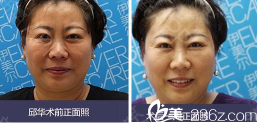 <!--<i data=20240703-sp></i>-->整形美容醫(yī)院提升面部案例分享