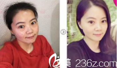 歷下寶琳娜醫(yī)療美容診所埋線提升案例分享