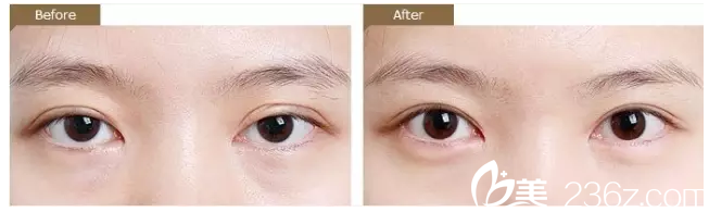雙眼皮不對稱修復(fù)案例 雙眼皮不對稱修復(fù)案例