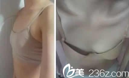 我在太原華美整形醫(yī)院做假體隆胸前照片 我在太原華美整形醫(yī)院做假體隆胸前照片