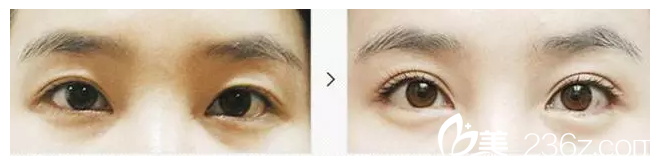 雙眼皮消失做修復(fù)案例 雙眼皮消失做修復(fù)案例