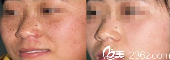 光子祛斑案例效果對(duì)比圖