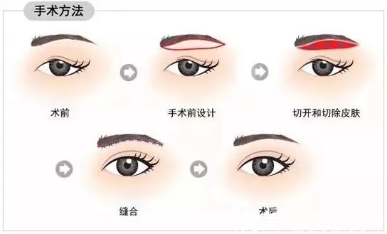 直接切眉術(shù)過(guò)程示意圖