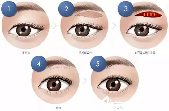 合并雙眼皮切眉術(shù)過(guò)程示意圖