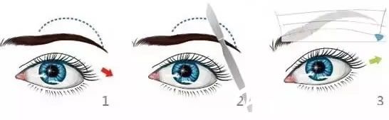 常規(guī)拉皮切眉術(shù)過(guò)程示意圖
