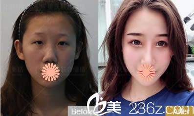 重慶聯(lián)合麗格黨寧眼綜合/鼻綜合案例效果圖 重慶聯(lián)合麗格黨寧眼綜合/鼻綜合案例效果圖