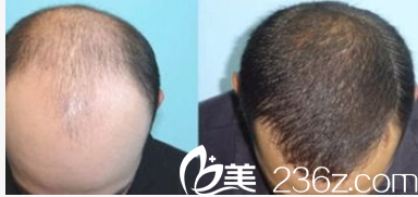 北京壹加壹郝文義自體毛發(fā)移植案例 北京壹加壹郝文義自體毛發(fā)移植案例