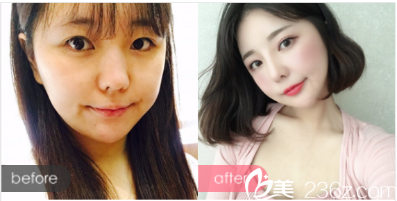 江門華美整形醫(yī)院毛孝忠做的鼻綜合隆鼻案例 江門華美整形醫(yī)院毛孝忠做的鼻綜合隆鼻案例