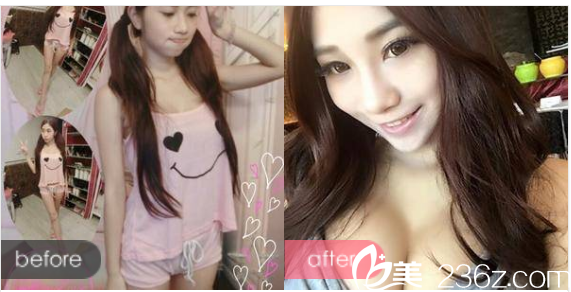 江門華美整形醫(yī)院毛孝忠做的自體脂肪隆胸案例對比圖 江門華美整形醫(yī)院毛孝忠做的自體脂肪隆胸案例對比圖