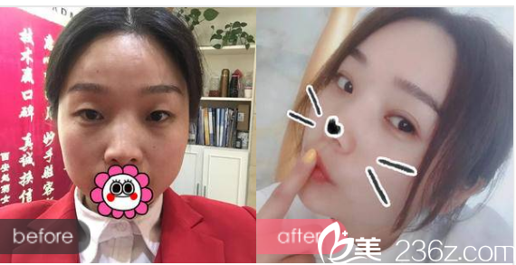 江門華美整形醫(yī)院常海做的雙眼皮案例