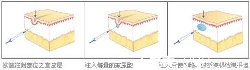 玻尿酸除皺特點(diǎn)