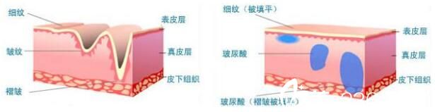 影響玻尿酸除皺價(jià)格因素