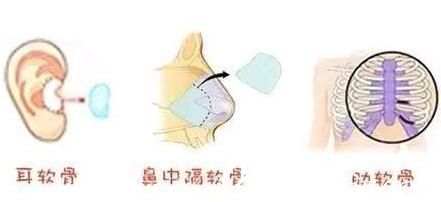 自體軟骨隆鼻常用的三個軟骨