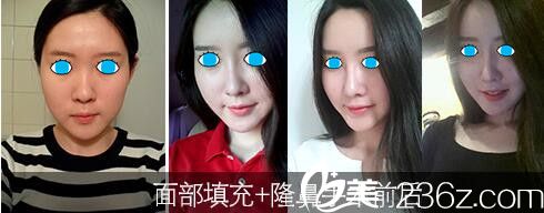 濟(jì)源萍面部填充和隆鼻案例