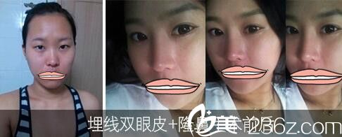 濟(jì)源萍雙眼皮和隆鼻案例