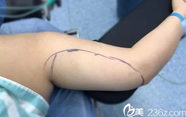 術(shù)前手臂劃線設(shè)計(jì) 術(shù)前手臂劃線設(shè)計(jì)